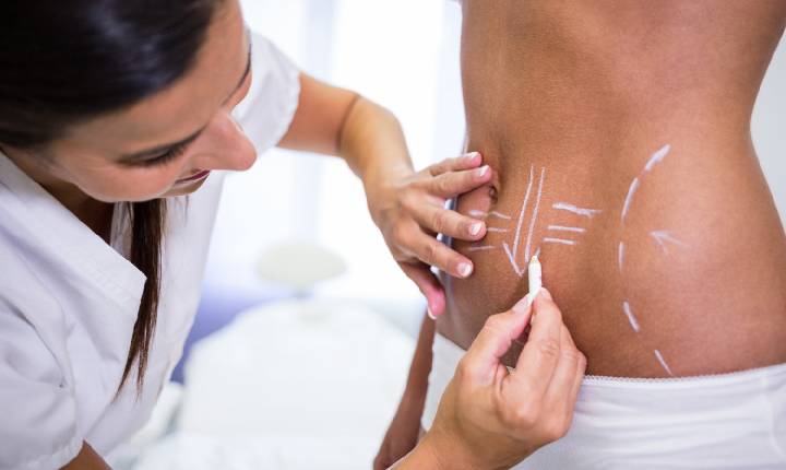 Lipo HD amplia possibilidades da definição corporal