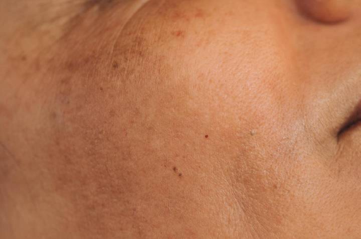 Manchas que vão além do espelho: o desafio das mulheres com Melasma