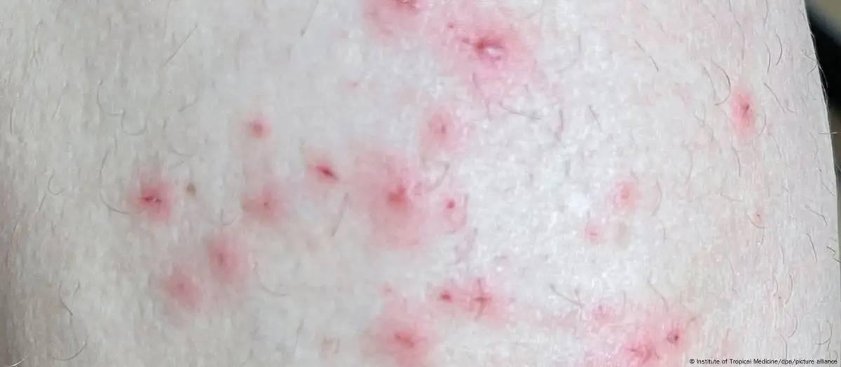 Mpox volta a ser uma emergência sanitária global, diz OMS