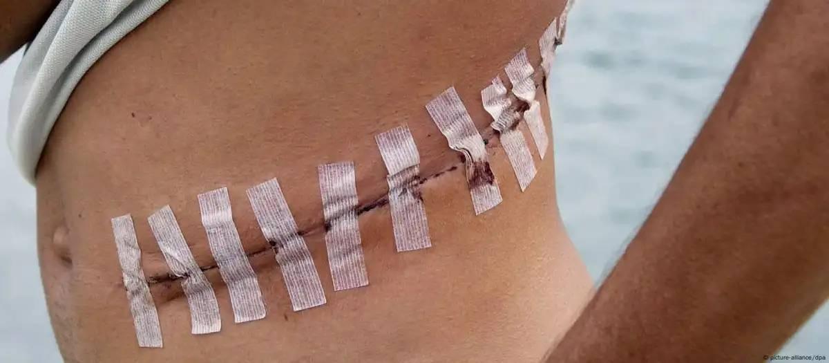 Entidades falam em epidemia de tráfico de órgãos na África