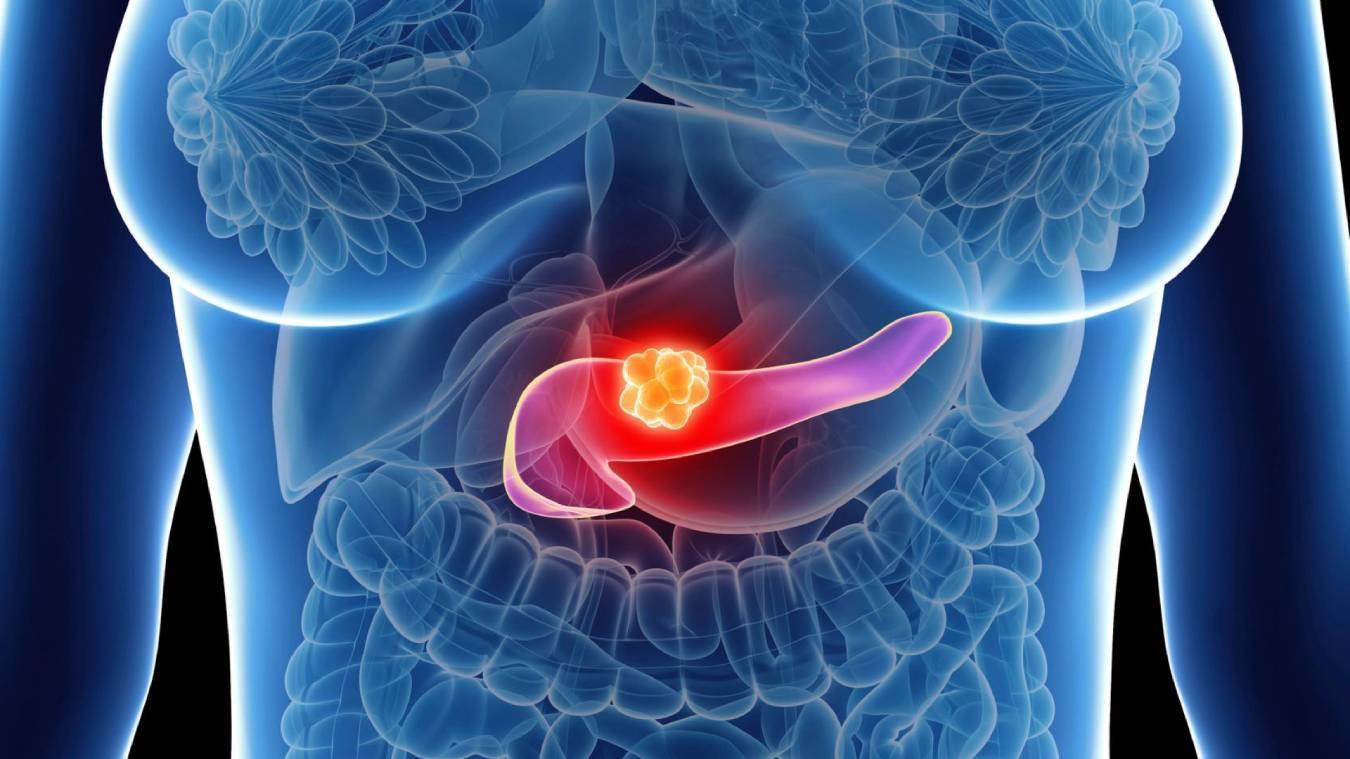 Metodologia inédita no País permite diagnóstico em tempo recorde para o câncer de pâncreas