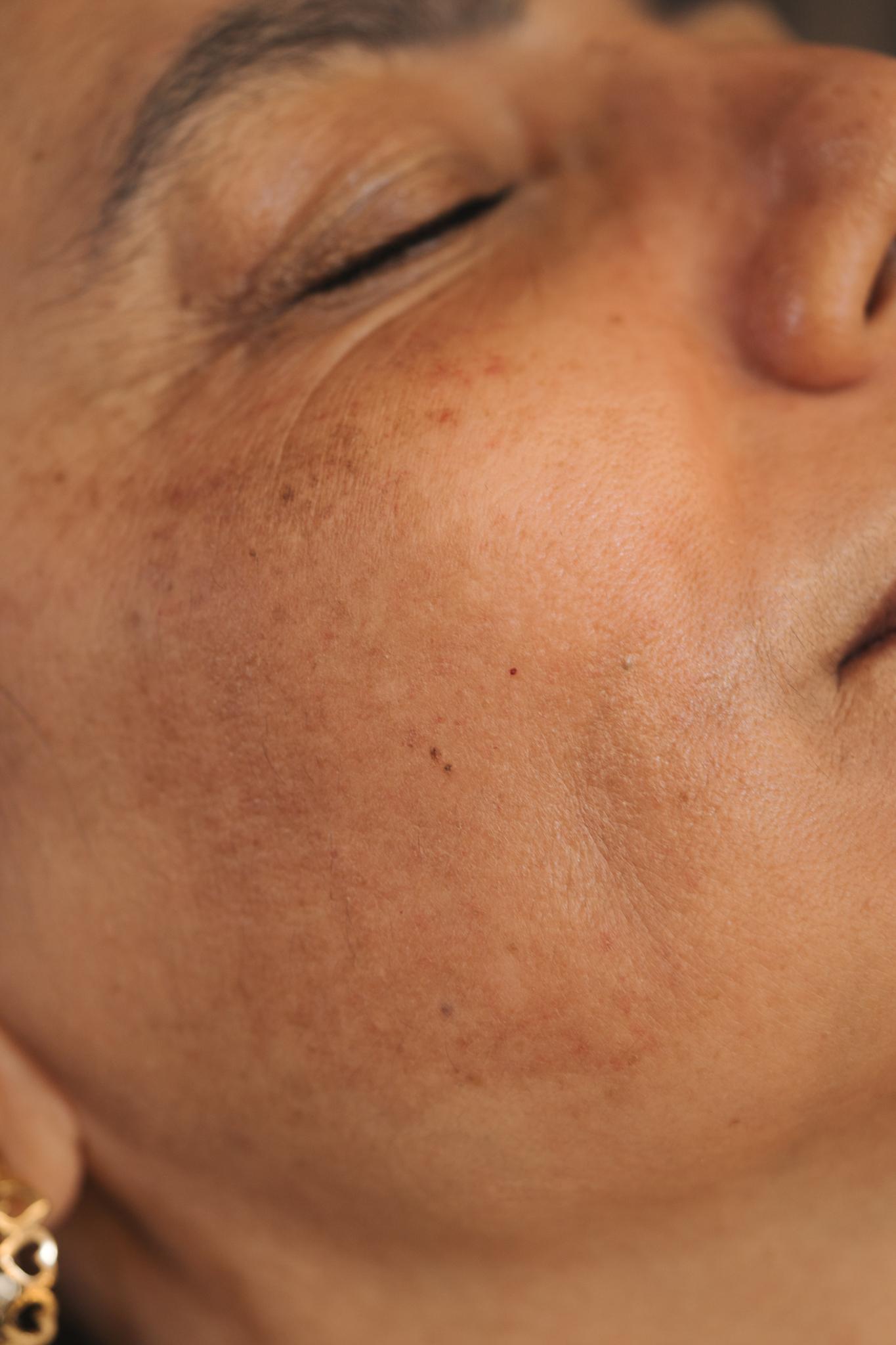 Manchas que vão além do espelho: o desafio das mulheres com Melasma